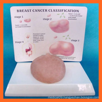 Human Breast Cancer Self-Exam Model